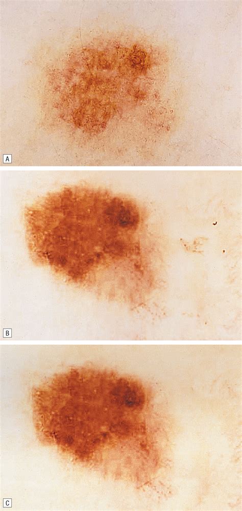 Ultraviolet Radiation of Melanocytic Nevi: A Dermoscopic Study ...