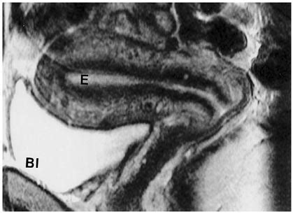 Normal uterus on magnetic resonance imaging. Sagittal T2-weighted... | Download Scientific Diagram