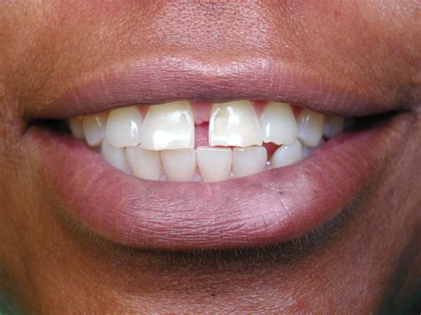 Closing a Mid-line Gap Between Upper Teeth – Dr. Mark Venincasa, DDS | General & Cosmetic ...