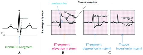 ECG – ProductiveMedic