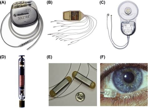 Implantable Neural Stimulators | Neupsy Key