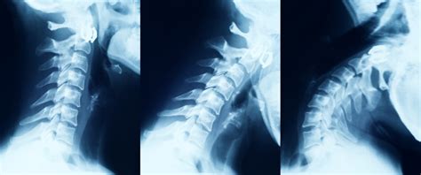 2nd Opinion Radiology Report on Craniocervical Instability-CCI