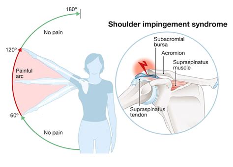 Shoulder Impingement: Symptoms, Causes, Treatment By Shoulder Braces