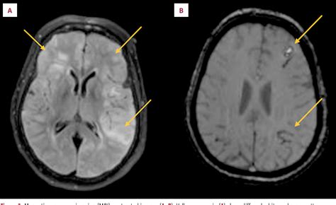 [PDF] When Brain Biopsy Solves the Dilemma of Diagnosing Atypical Cerebral Amyoild Angiopathy: A ...