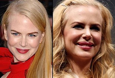 Nicole Kidman Plastic Surgery - Rumors or Facts?