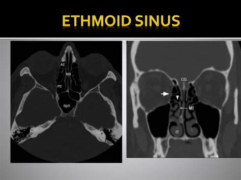 CT ANATOMY OF PARA NASAL SINUSES