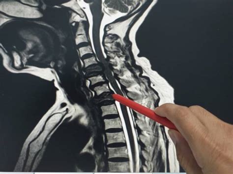 Mri Cervical Spine Stock Photos, Pictures & Royalty-Free Images - iStock