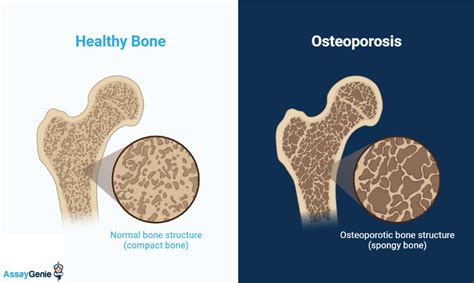 Understanding Bone Resorption: Key Definitions and Processes - Assay Genie