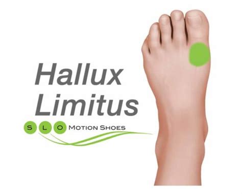 Arthritis of Big Toe Joint (Hallux Rigidus) - SLO Motion ShoesSLO ...