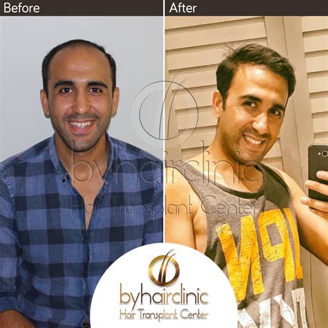 Home – bysacekimi hair transplantation in istanbul Turkey