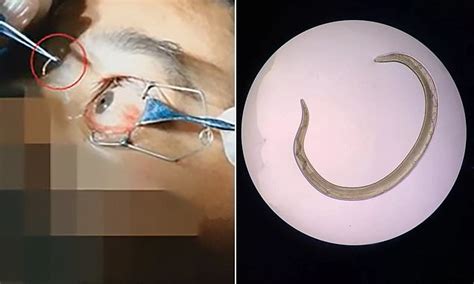 Doctor plucks a 'swimming' parasitic worm from a man's eye | Daily Mail ...