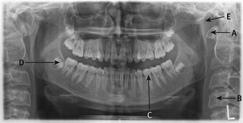 Interpreting a normal orthopantomogram | The BMJ