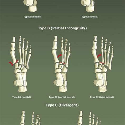 The Myerson's Classification of Lisfranc Injuries [48] (From Stavlas et ...