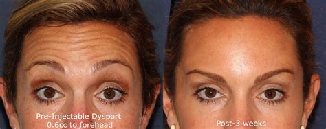 This beautiful smooth forehead was achieved with Dysport! #clderm | Dysport, Botox, Cosmetic ...