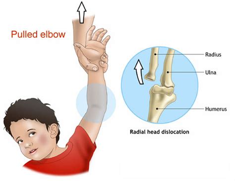 Dislocated Elbow - Causes, Signs, Symptoms, Recovery & Treatment