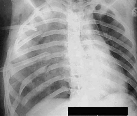 Chest X-ray showing a flail chest of the right haemithorax with two... | Download Scientific Diagram