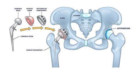 Hip Replacement Surgery | NewYork-Presbyterian