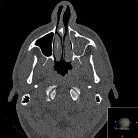 Acute Rhinosinusitis - Causes - Investigations - Management - TeachMeSurgery