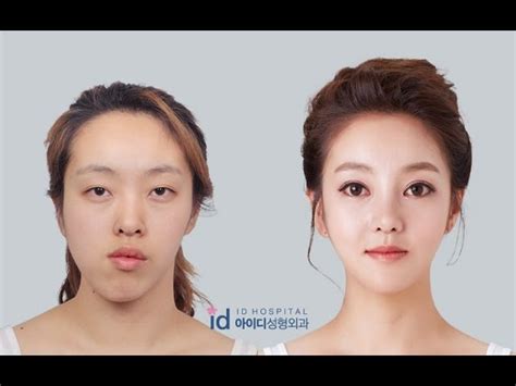 Asymmetrical Face Surgery Before And After