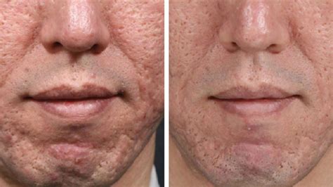 Microneedling for Acne Scars: Effectiveness, Side Effects, and Costs