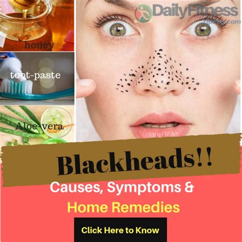 Blackheads : Causes, Symptoms And Home Remedies