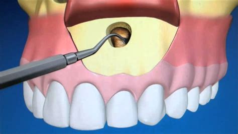 What is apicoectomy and when it can be useful