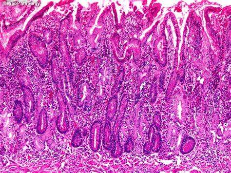 Webpathology.com: A Collection of Surgical Pathology Images