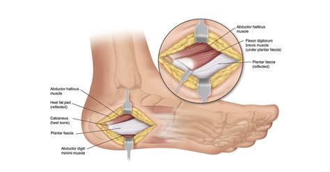 Plantar Fasciitis Surgery & Recovery Info | Heel That Pain