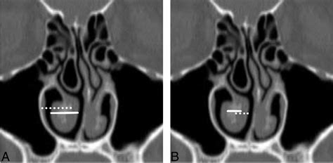 Figure 2 from The Impact of Middle Turbinate Concha Bullosa on the Severity of Inferior ...