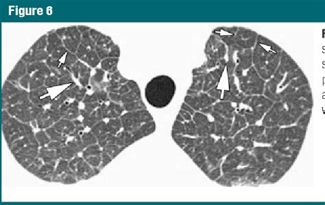 Thin-section CT of the secondary pulmonary lobule: anatomy and the ...