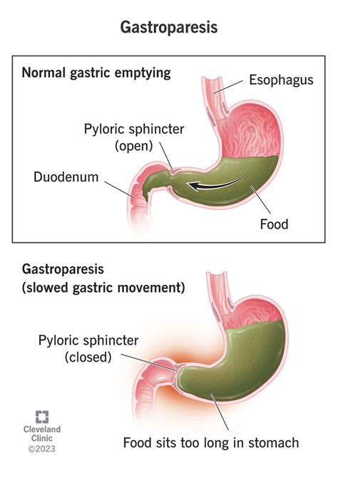 Gastroparesis: Symptoms, Causes, Diagnosis & Treatment