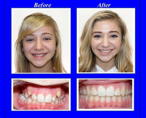 This patient had a very narrow upper jaw and her back teeth were in ...