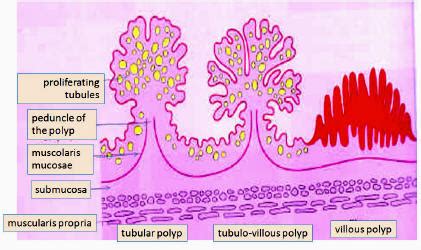 Villous Adenoma Vs Tubular Adenoma