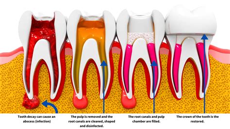 Root Canal Therapy | Pembroke Dental Associates | Pembroke Pines, FL