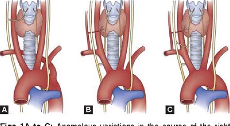 Figure 1 from Nonrecurrent Laryngeal Nerve: A Case Report and a Review ...