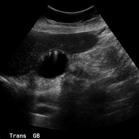 Gallbladder adenomyomatosis | Radiology Case | Radiopaedia.org ...