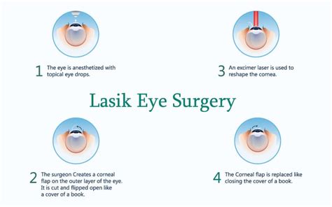 lasik-process | Sibia Eye Institute