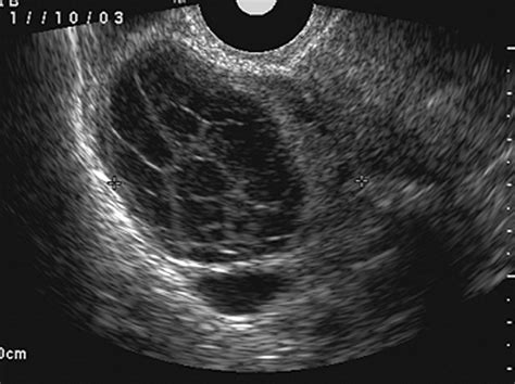 Imaging of Adnexal Masses in Pregnancy | Ultrasound, Diagnostic medical sonography, Diagnostic ...