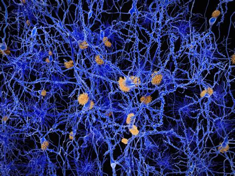 Neuritic plaque | neurology | Britannica