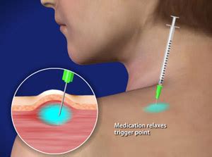 Trigger Points - West Valley Pain Solutions