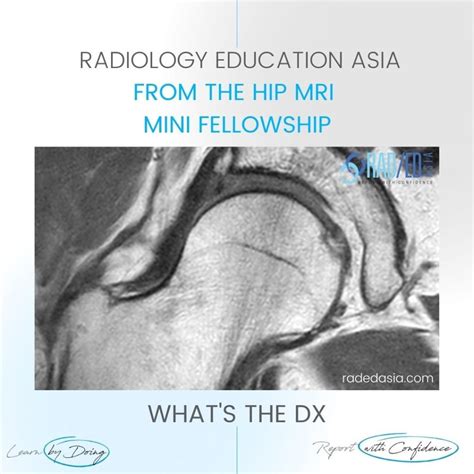 MRI HIP CAM FAI FEMORO ACETABULAR IMPINGEMENT - Radedasia