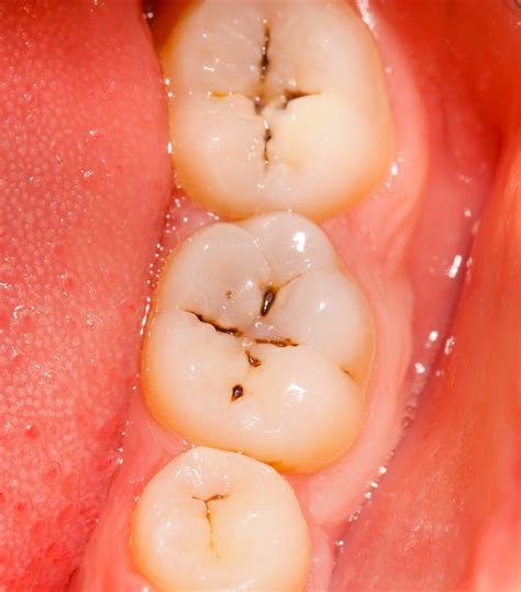 Pit and fissure caries
