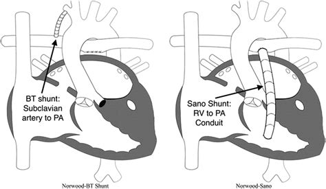 Modified Blalock-Taussig (BT) shunt and right ventricle (RV) to ...