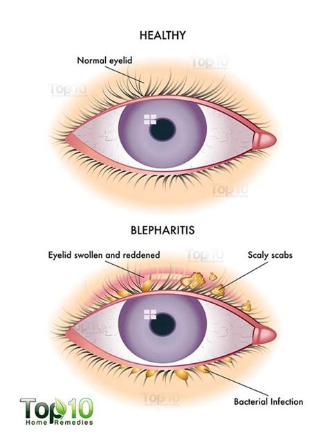 Blepharitis: Tips and Remedies to Relieve Eyelid Inflammation | Top 10 ...