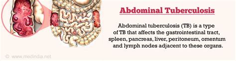 Stomach / Intestinal / Abdominal Tuberculosis - Causes, Symptoms, Diagnosis, Treatment