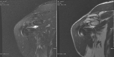 Coronal view of Rt. Shoulder MRI (SLAP lesion). | Download Scientific ...