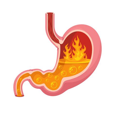 What is Acid Reflux? | UofL Health