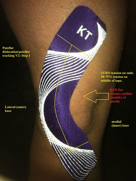 KT Tape for Patella Sublaxation | Kt tape knee, Knee taping, Kt tape