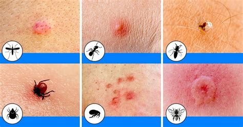 10 insect bites/stings that you should learn to recognize this summer