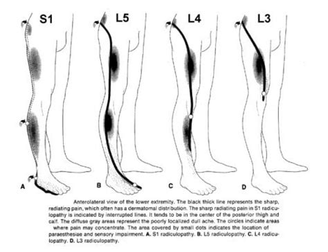 Radiculopathy Rapid Review: Cervical and Lumbar Patterns - Smarty PANCE